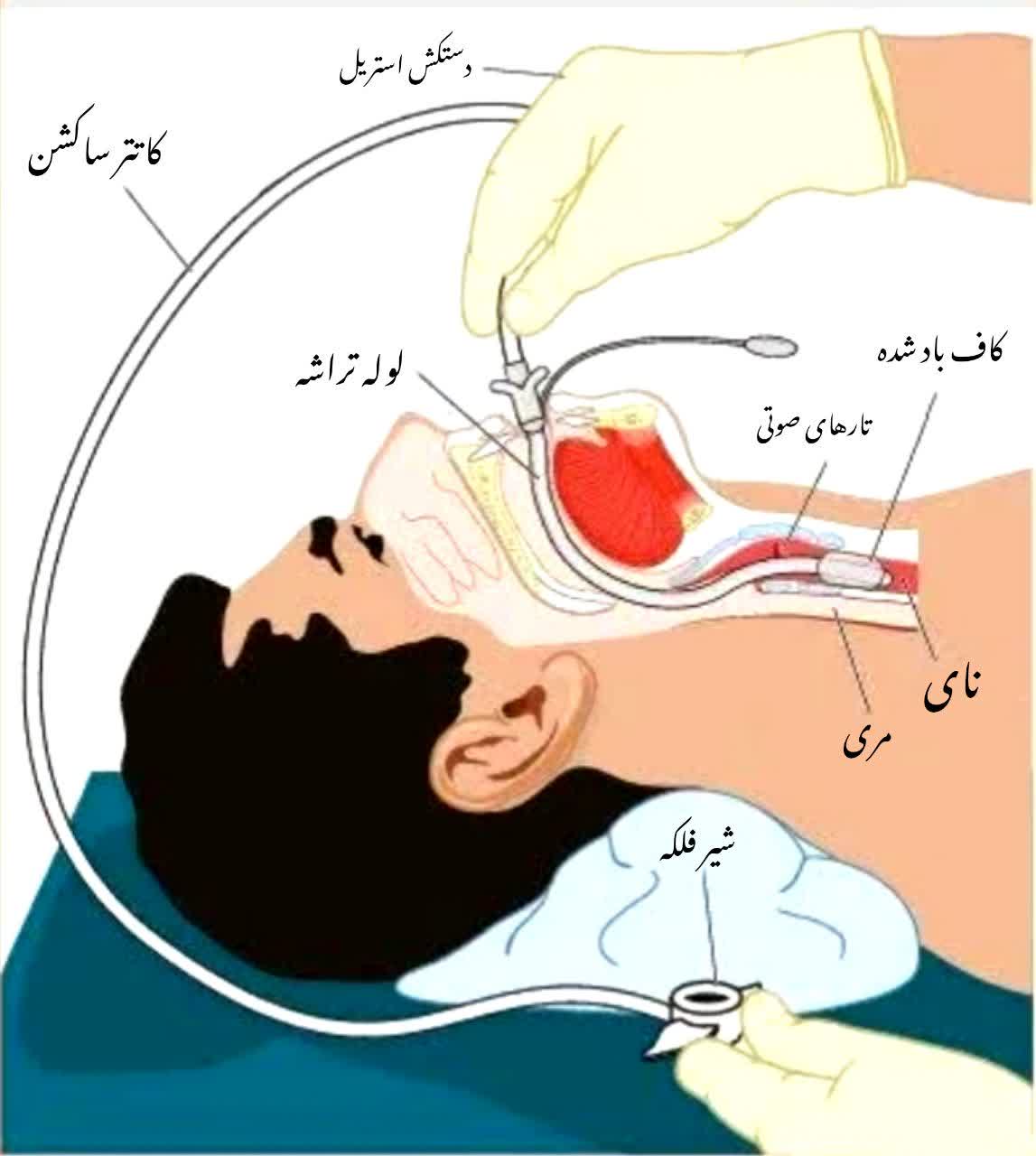 تعمیرات دستگاه ساکشن در اهواز