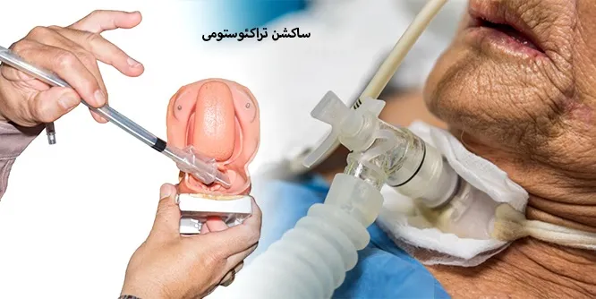 تراکستومی