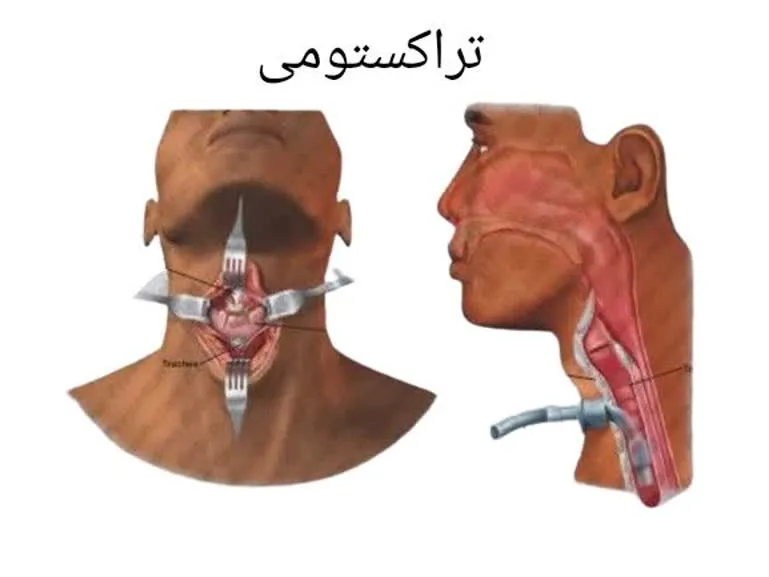 تراکستومی